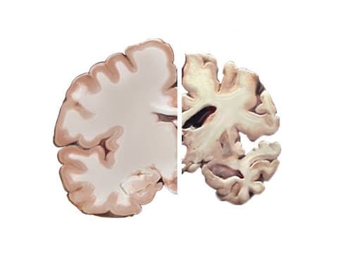 Alzheimer a mozek